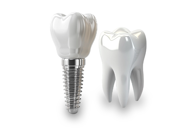 Implant Restorations
